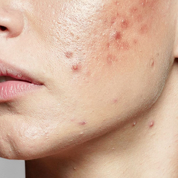 Illustration representing active facial acne on skin surface