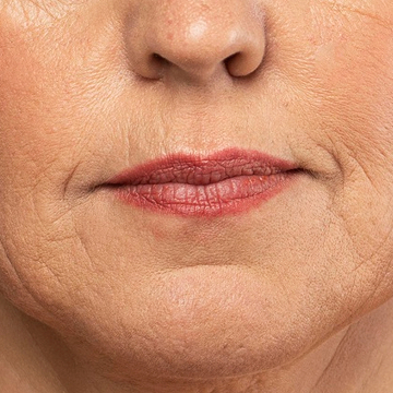 Illustration highlighting common areas affected by facial lines and wrinkles