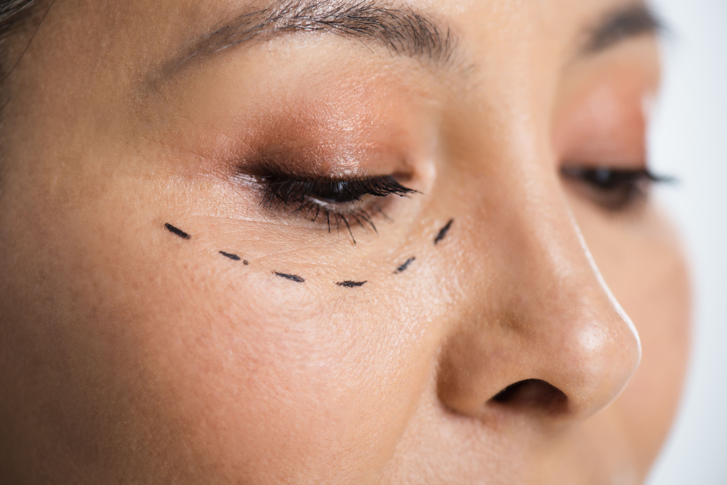 https://www.idsclinic.com/wp-content/uploads/2025/10/eyebag-removal.jpgEyebag Removal