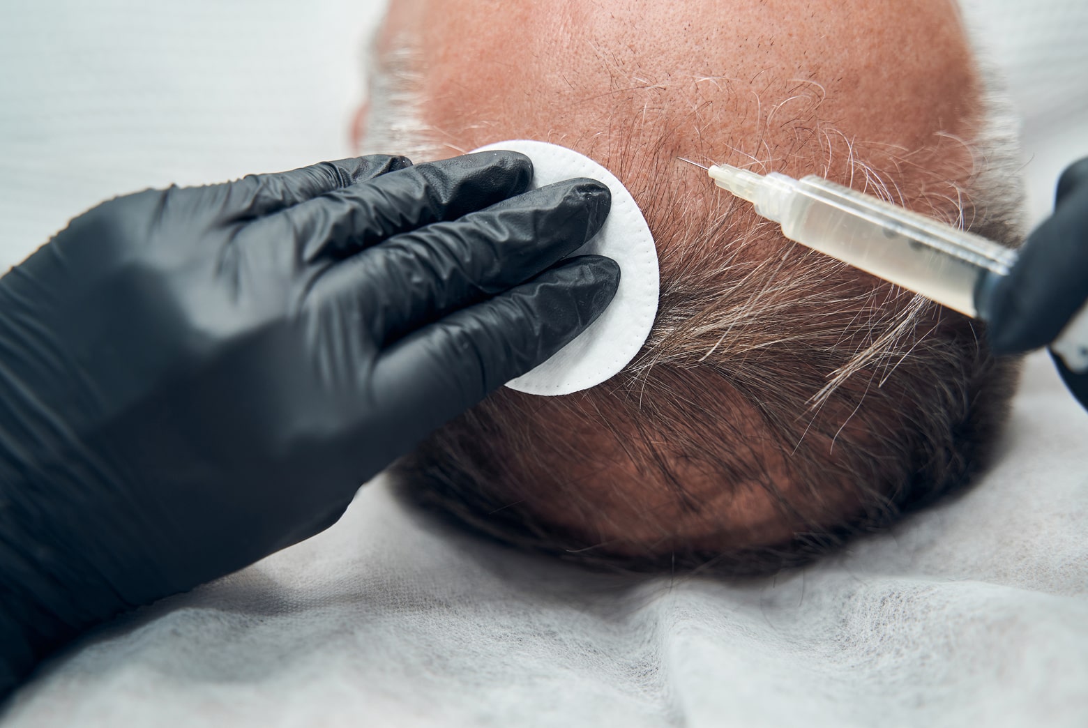 Why Perform a Surgical FUE Hair Transplant
