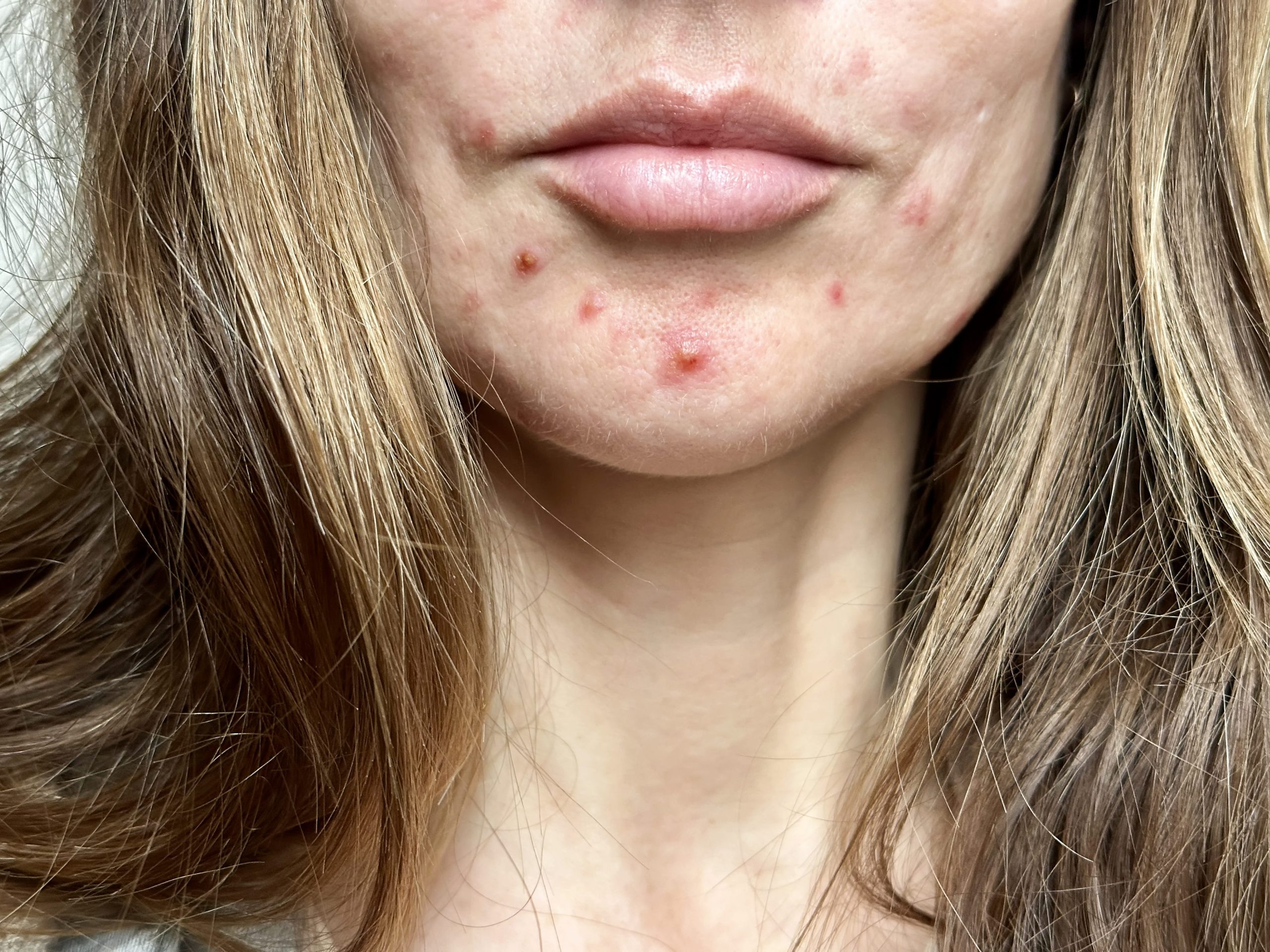 https://www.idsclinic.com/wp-content/uploads/2026/10/close-up-of-skin-with-blemishes-and-imperfections-2026-09-23-19-09-49-utc-1-scaled.jpgCystic Acne Treatment in Singapore