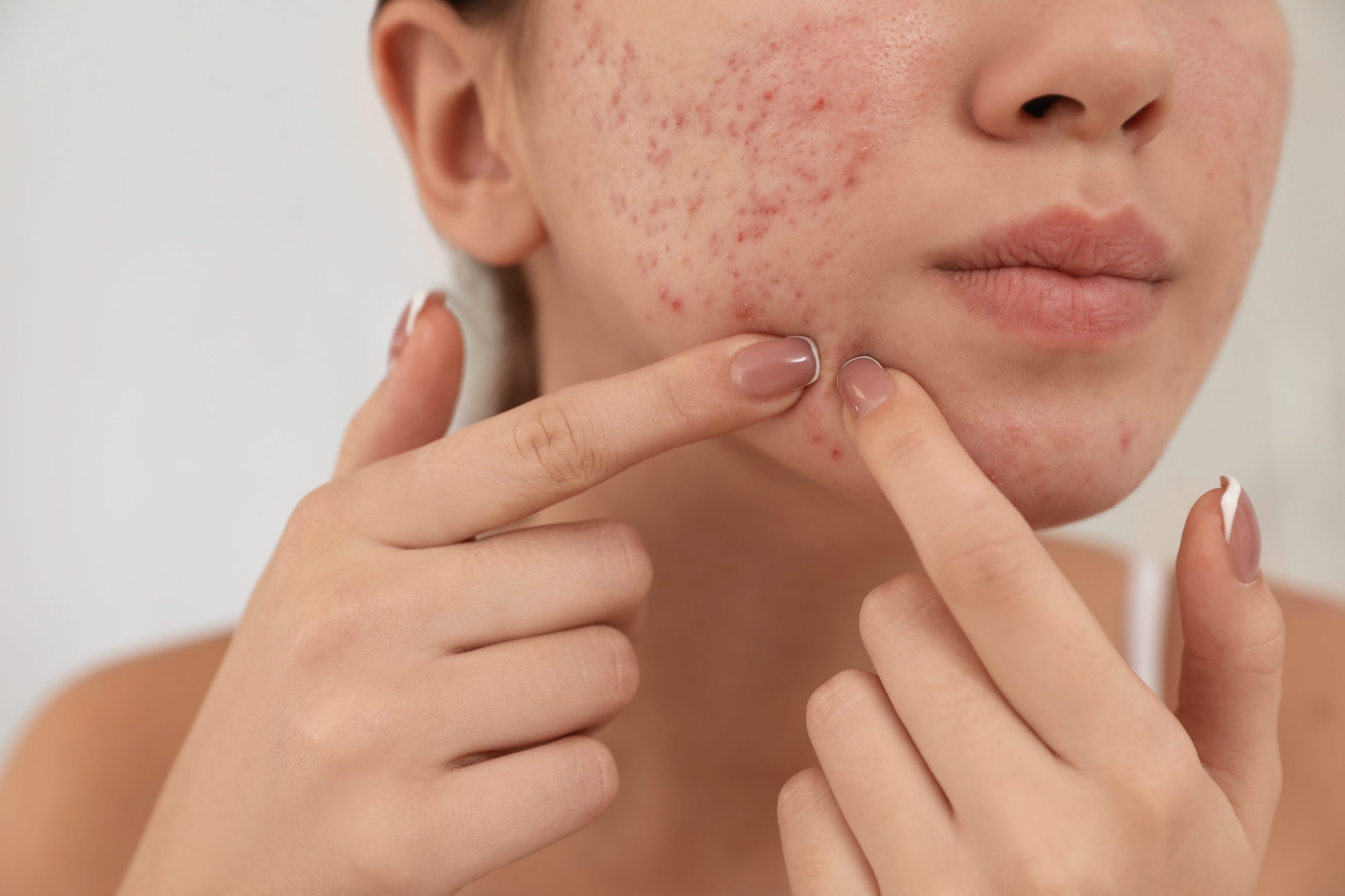 close up of woman s face with acne 2026 09 22 11 41 13 utc 1 scaled